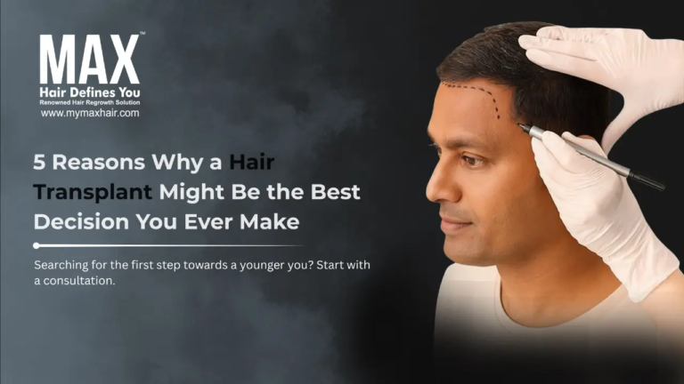 5 Reasons Why a Hair Transplant Might Be the Best Decision You Ever Make