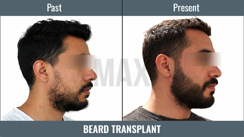 BEARD TRANSPLANT