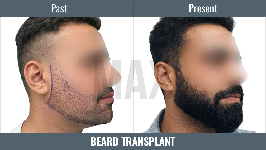 BEARD TRANSPLANT 2