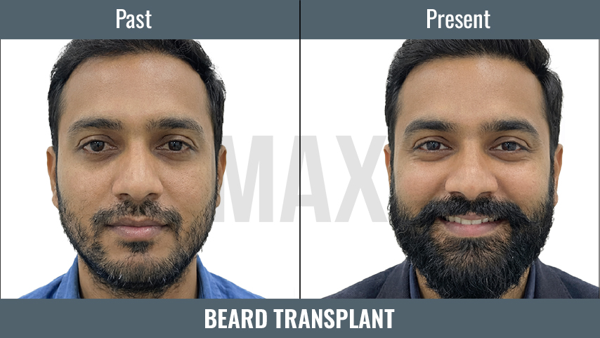 BEARD TRANSPLANT 3