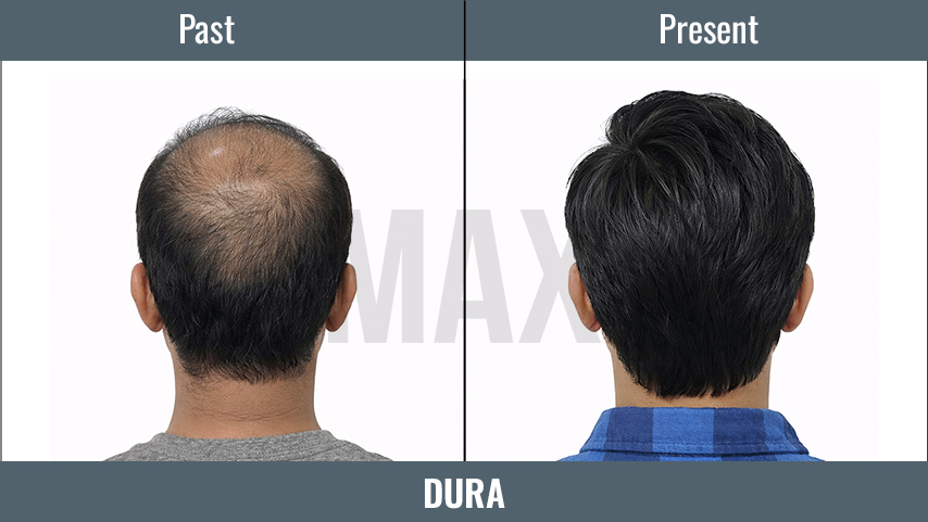 DURA 2