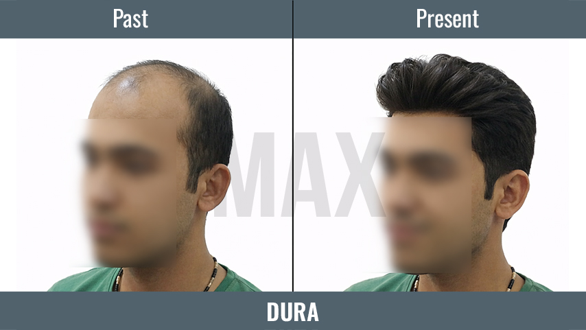 DURA 3