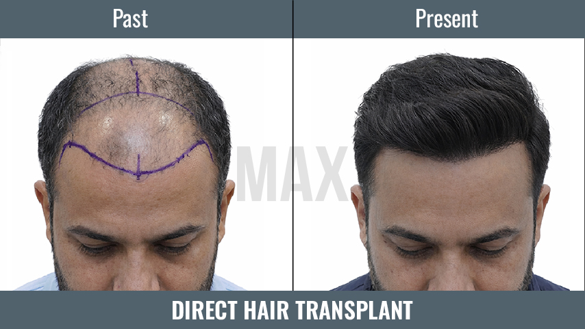 Direct Hair Transplant 2