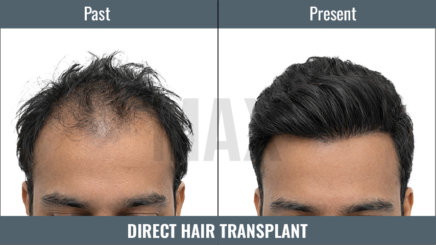 Direct Hair Transplant 3