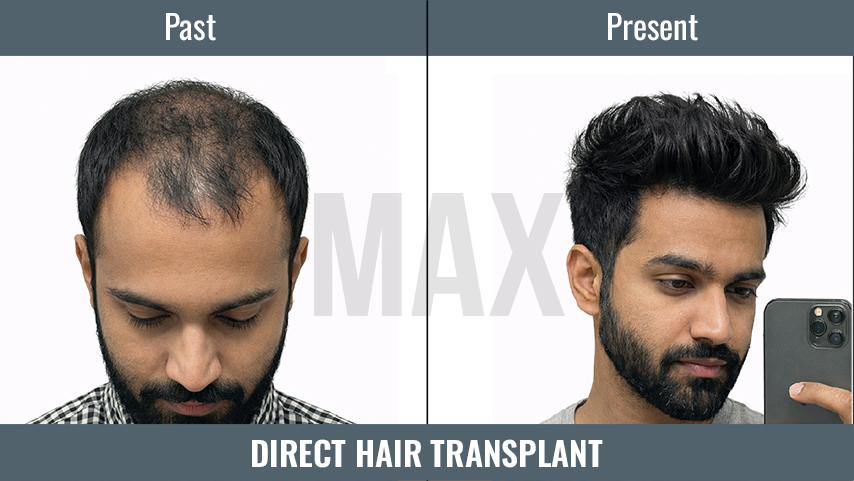 Direct Hair Transplant_