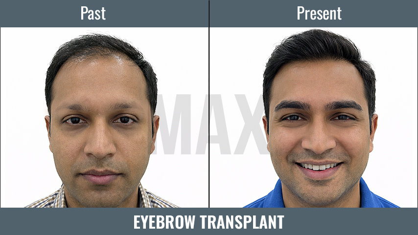 EYEBROW Transplant 2