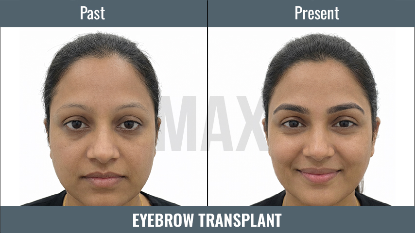 EYEBROW Transplant 3