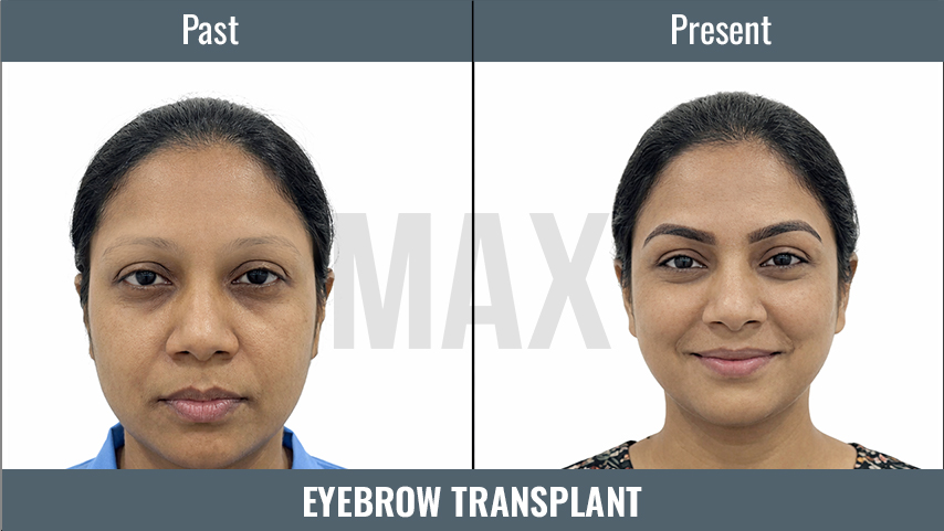 EYEBROW Transplant_