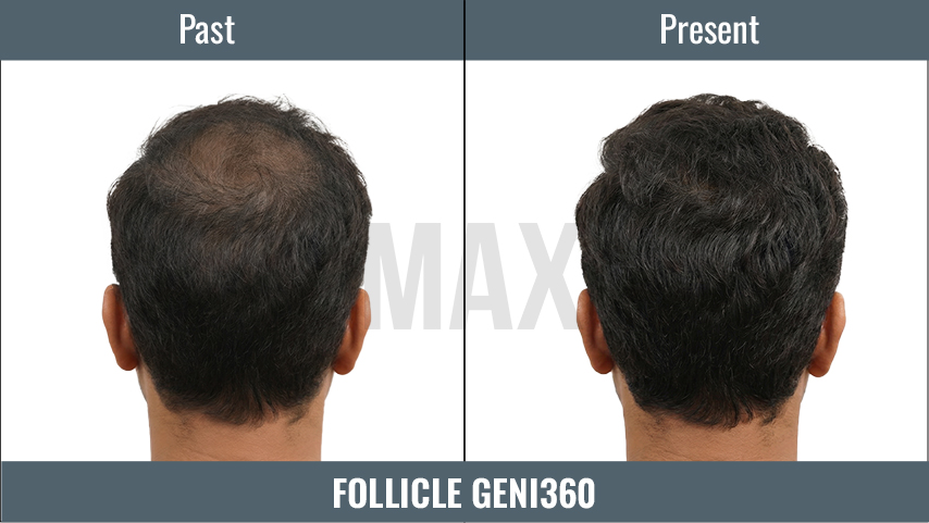 Follicle GenI360 2
