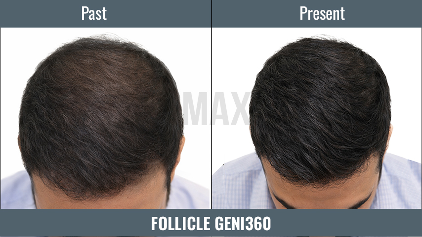 Follicle GenI360 3