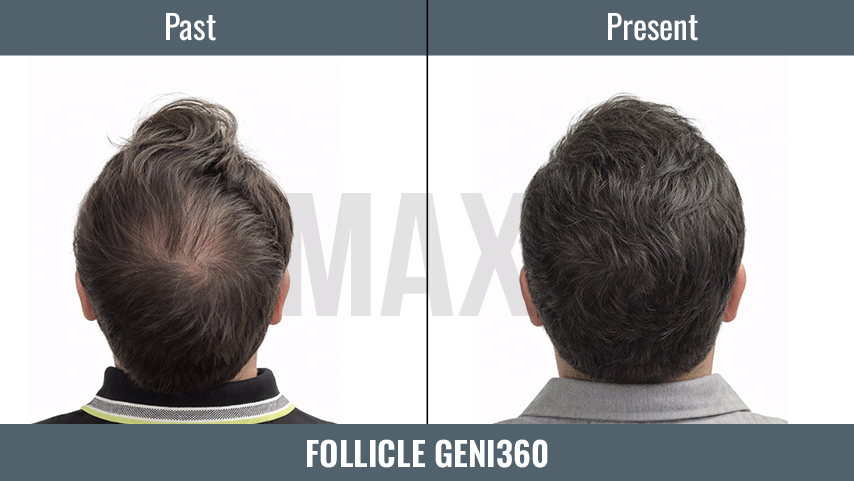 Follicle GenI360