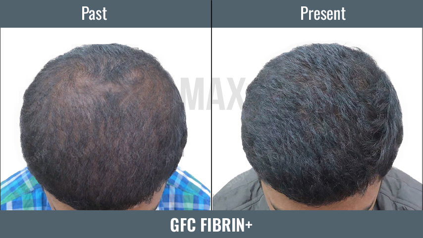 GFC 2