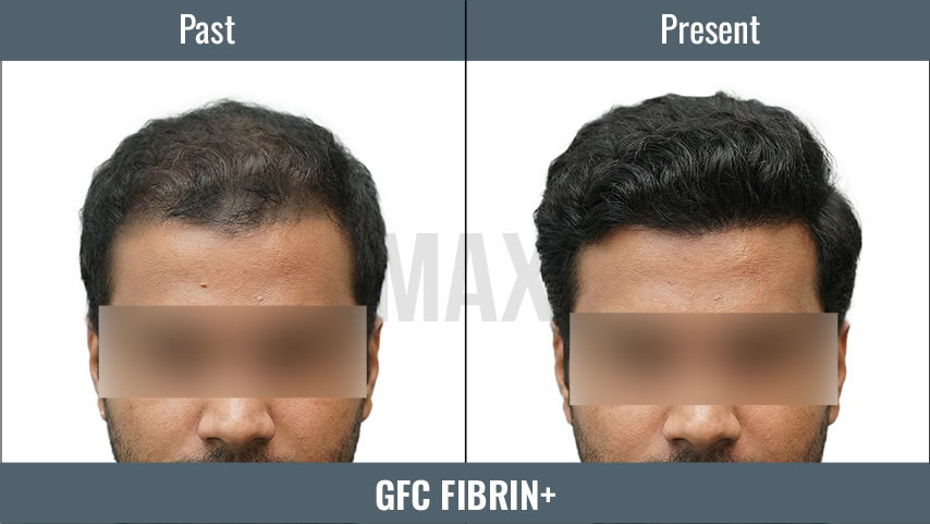 GFC 3