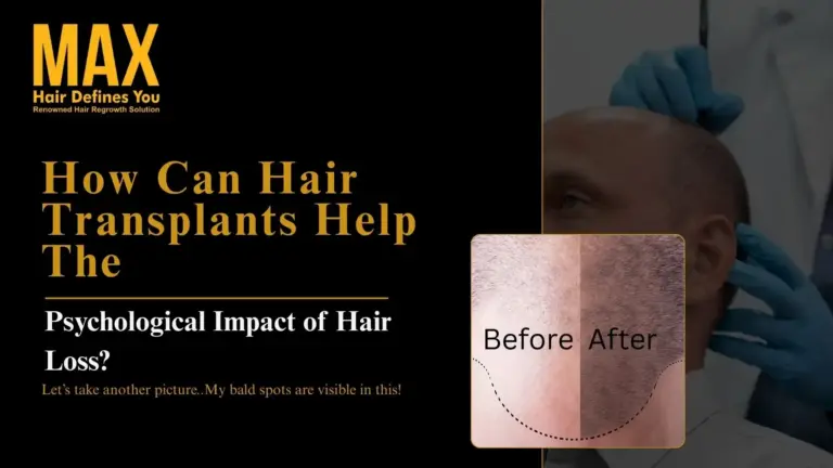 How Hair Transplants Help with the Psychological Effects of Hair Loss