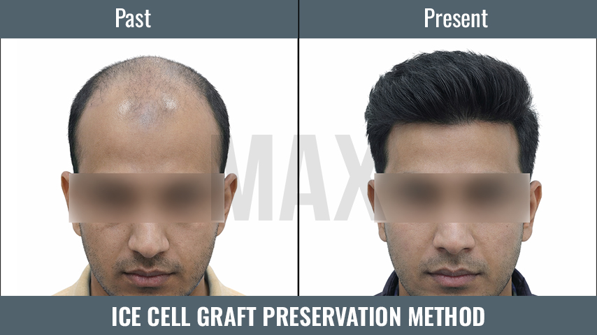 ICE Cell Graft Preservation Method 2