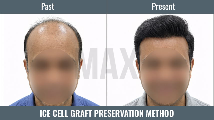 ICE Cell Graft Preservation Method 3