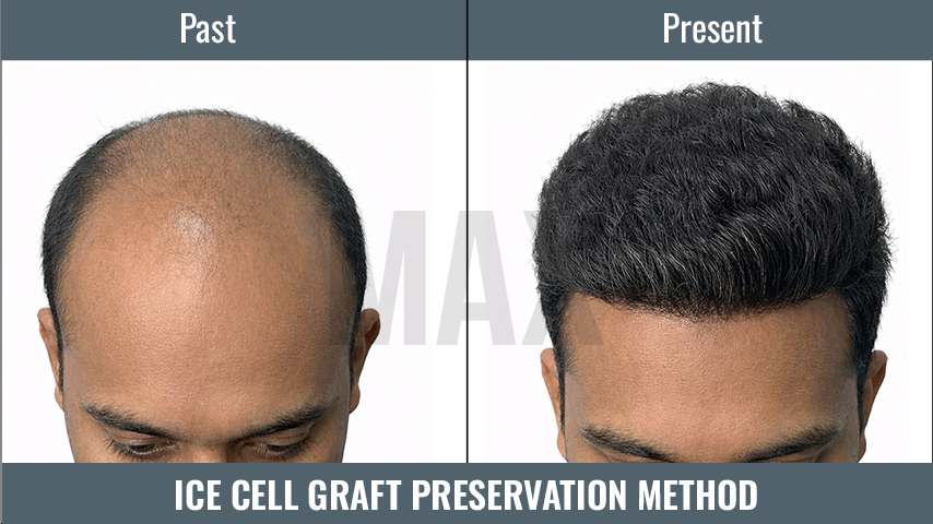 ICE Cell Graft Preservation Method_