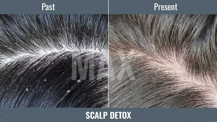 Scalp DETOX 2