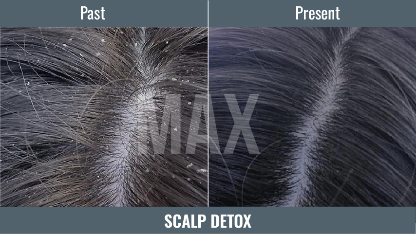 Scalp DETOX