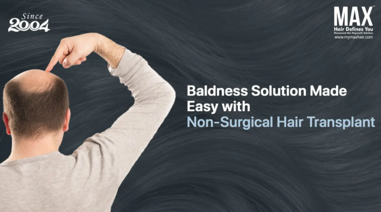 Say Goodbye to Baldness with Easy Non-Surgical Hair Restoration