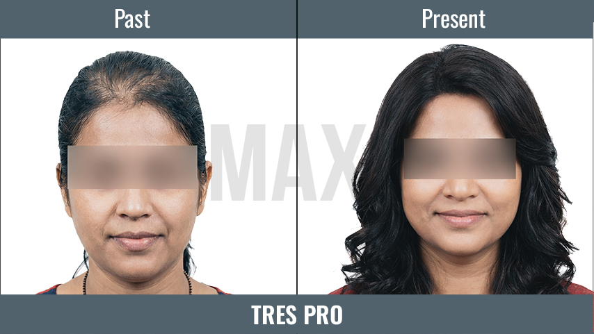 tres pro in india
