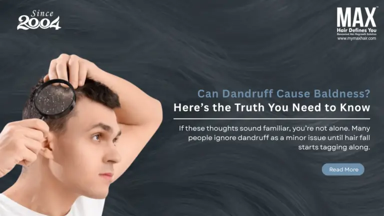 Can Dandruff Cause Baldness