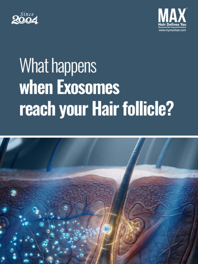 best hair replacement in bangalore