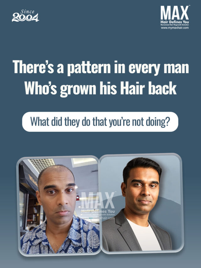 best hair transplant clinic