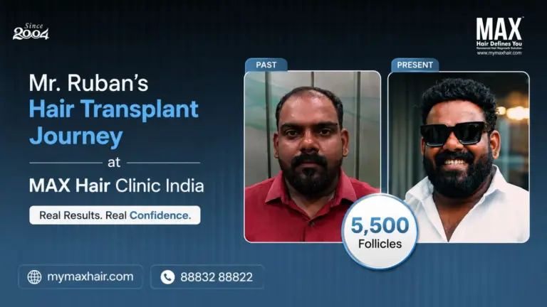 Mr. Ruban's Hair Transplant Journey