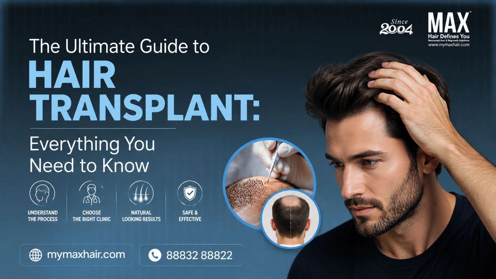 The Ultimate Guide to Hair Transplant